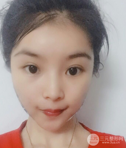 埋埋蛋白線(xiàn).提升恢復(fù)圖，原來(lái)小V臉不一定要磨骨