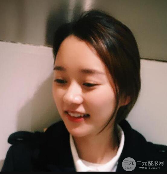 自體脂肪全臉填充三個(gè)月恢復(fù)圖，真實(shí)案例分享