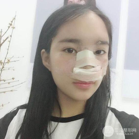 隆鼻整形術前術后對比照曝光，附經驗分享及心得體會