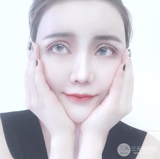 原來我和baby的距離只差一個(gè)網(wǎng)紅套餐，“雙眼皮+自體脂肪填充+豐唇”術(shù)后真人反饋