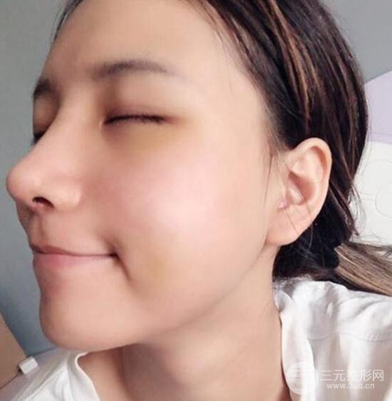 揚(yáng)州艾菲斯醫(yī)療美容張健隆鼻整形恢復(fù)記錄