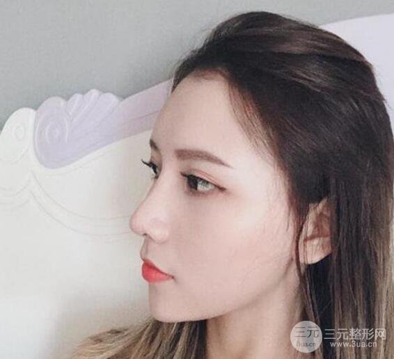 隆鼻整形手術(shù)三個月后真人果圖