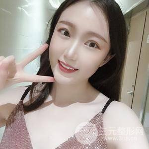 切開雙眼皮+上瞼下垂矯正術(shù)前術(shù)后果對比圖