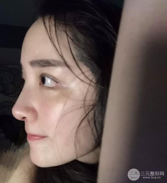 東莞寶格麗韋文奇隆鼻整形果圖分享，對比曝光