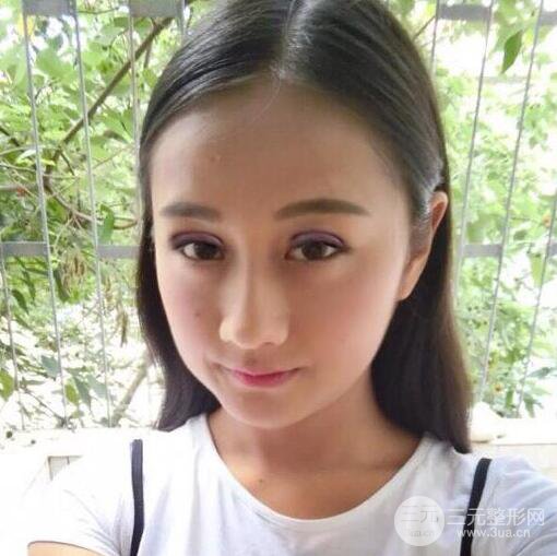 威高梨花醫(yī)療美容金成鎬全切雙眼皮+開眼角術后恢復記錄