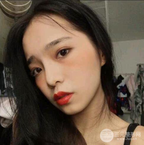 隆鼻整形術前術后對比照曝光，附經驗分享及心得體會