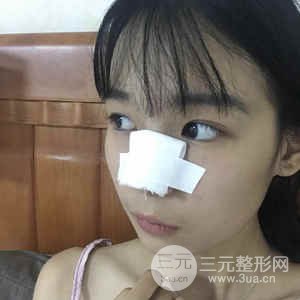 肋軟骨隆鼻果對比圖