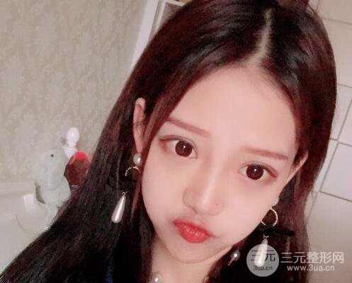 割雙眼皮多久會恢復(fù)