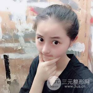 網(wǎng)紅鼻整形三十天恢復(fù)記錄