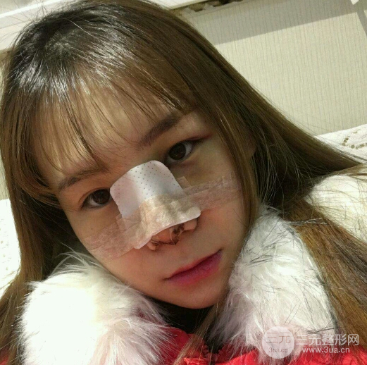 隆鼻整形三個(gè)月恢復(fù)真實(shí)圖片，做完土妹子變網(wǎng)紅辣