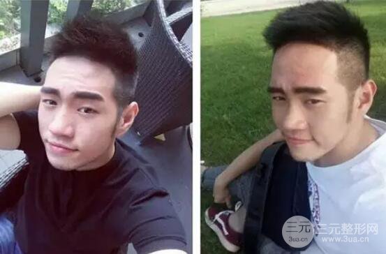 硅膠隆鼻一至7天恢復(fù)圖