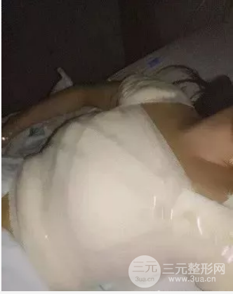 假體隆胸恢復(fù)期3個(gè)月圖片，真人日記曝光