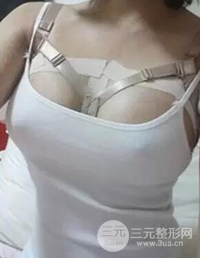 假體隆胸分享日記