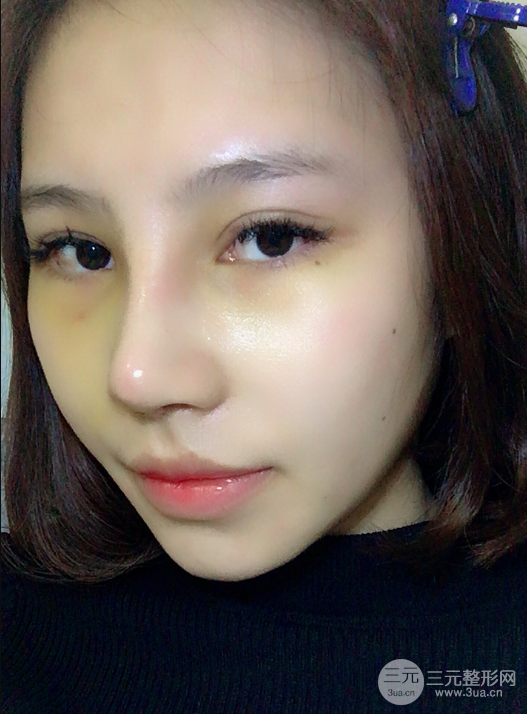 自體脂肪填充面部案例,神奇的變臉術(shù)