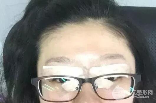 雙眼皮手術(shù)后恢復(fù)期記錄