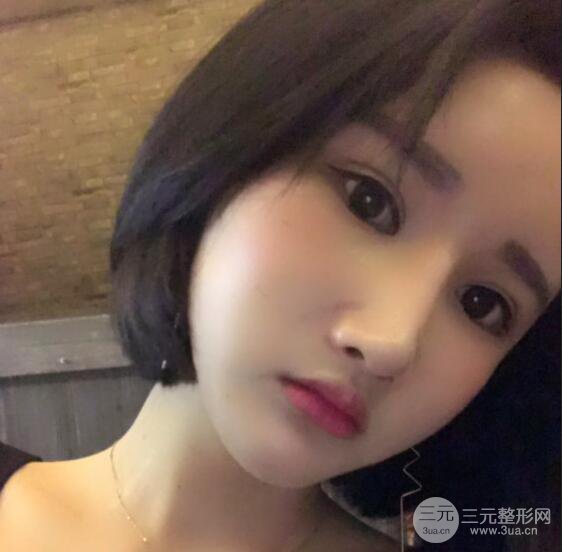 去下頜角+顴骨內(nèi)推手術(shù)三個(gè)月記錄，看大臉妹如何逆襲
