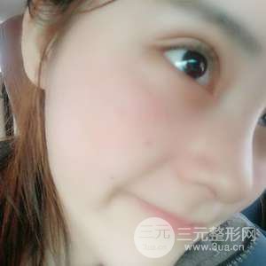 網(wǎng)紅鼻整形三十天恢復(fù)記錄