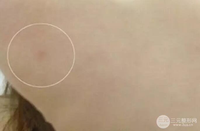 抽手臂脂肪的恢復(fù)過程