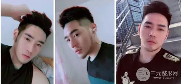 硅膠隆鼻一至7天恢復(fù)圖