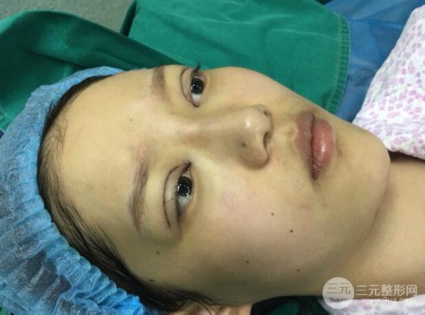 割雙眼皮多久會恢復(fù)
