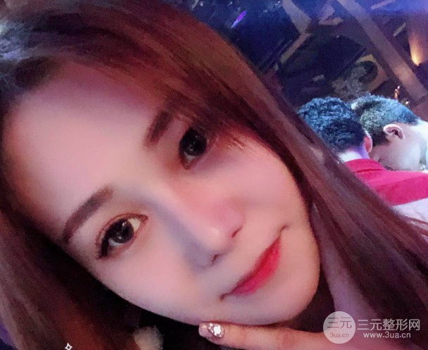 隆鼻整形三個(gè)月恢復(fù)真實(shí)圖片，做完土妹子變網(wǎng)紅辣