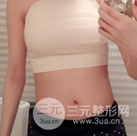 自體脂肪隆胸恢復圖曝光，見證從A到C的蛻變