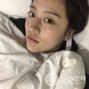 面部吸脂100天恢復(fù)果對比圖