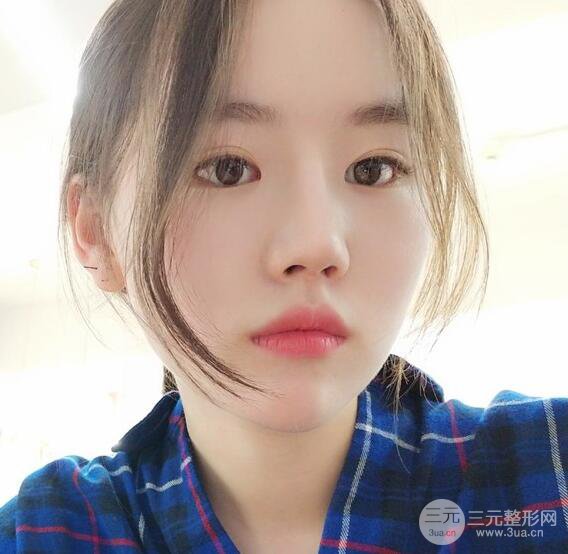 上海華美醫(yī)療美容李庭勛膨體隆鼻怎么樣？果對(duì)比圖