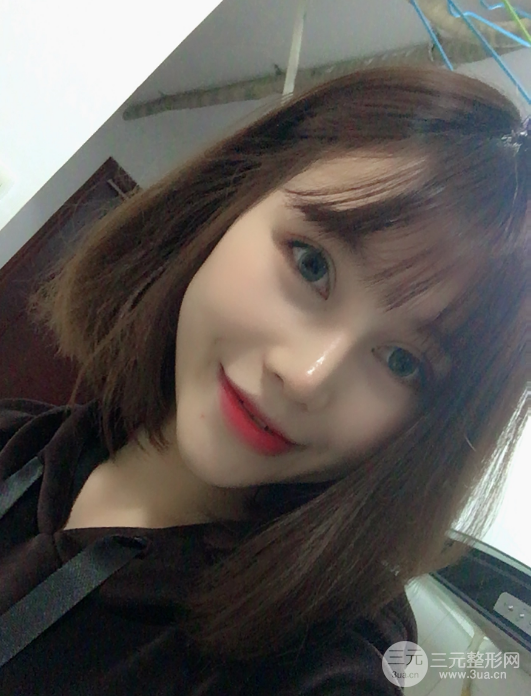 自體脂肪填充面部案例,神奇的變臉術(shù)