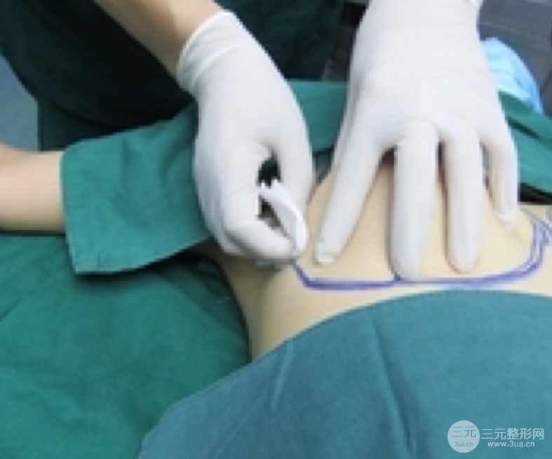 自體脂肪隆胸恢復圖曝光，見證從A到C的蛻變