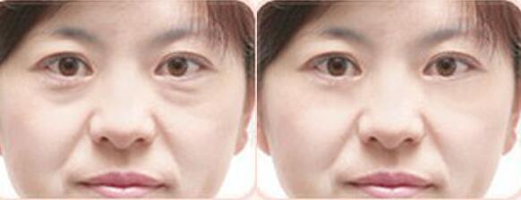 整形手術(shù)祛眼袋