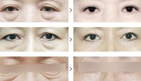 上海祛眼袋手術(shù)多少錢|全新價格表,祛眼袋手術(shù)前后對比圖