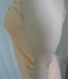 大家看看我在北京麗都陳萬芳醫(yī)生做的手臂吸脂怎么樣