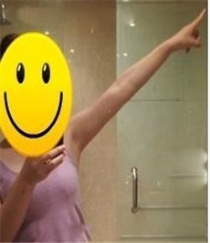 大家看看我在北京麗都陳萬芳醫(yī)生做的手臂吸脂怎么樣