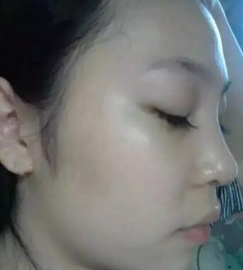 我的假體隆鼻恢復過程,有圖有真相哦~