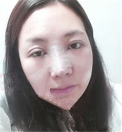米揚(yáng)麗格巫文云做的鼻部修復(fù)，恢復(fù)得不錯(cuò)了
