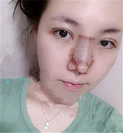 米揚(yáng)麗格巫文云做的鼻部修復(fù)，恢復(fù)得不錯(cuò)了