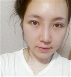 米揚(yáng)麗格巫文云做的鼻部修復(fù)，恢復(fù)得不錯(cuò)了