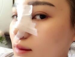 四川嬌點整形醫(yī)院的姜宇祿院長給我做的隆鼻整形，分享給大家看看