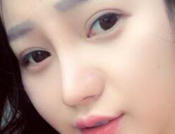 四川嬌點整形醫(yī)院的姜宇祿院長給我做的隆鼻整形，分享給大家看看