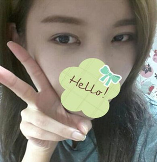 一起來評(píng)價(jià)一下重慶愛思特盧剛醫(yī)生做的切開雙眼皮吧