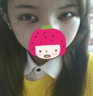 一起來評(píng)價(jià)一下重慶愛思特盧剛醫(yī)生做的切開雙眼皮吧