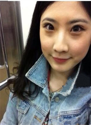 重慶愛思特鄭東學(xué)做的駝峰鼻矯正變美了
