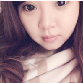 董薇薇醫(yī)師為我做的玻尿酸墊下巴術(shù)前術(shù)后對(duì)比照