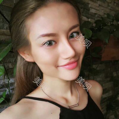 美圣美醫(yī)院任志偉為我做的自體脂肪面部填充恢復(fù)過程