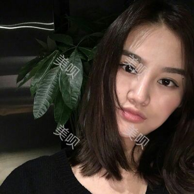 美圣美醫(yī)院任志偉為我做的自體脂肪面部填充恢復(fù)過程