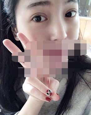 做埋線雙眼皮一周啦~果滿滿的！