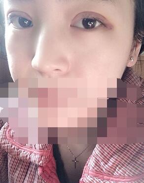 做埋線雙眼皮一周啦~果滿滿的！