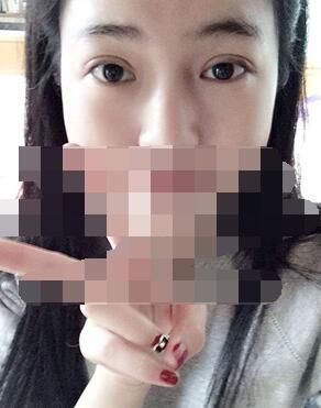 做埋線雙眼皮一周啦~果滿滿的！