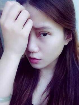 割雙眼皮半個(gè)月了 有雙眼皮的感覺真爽！